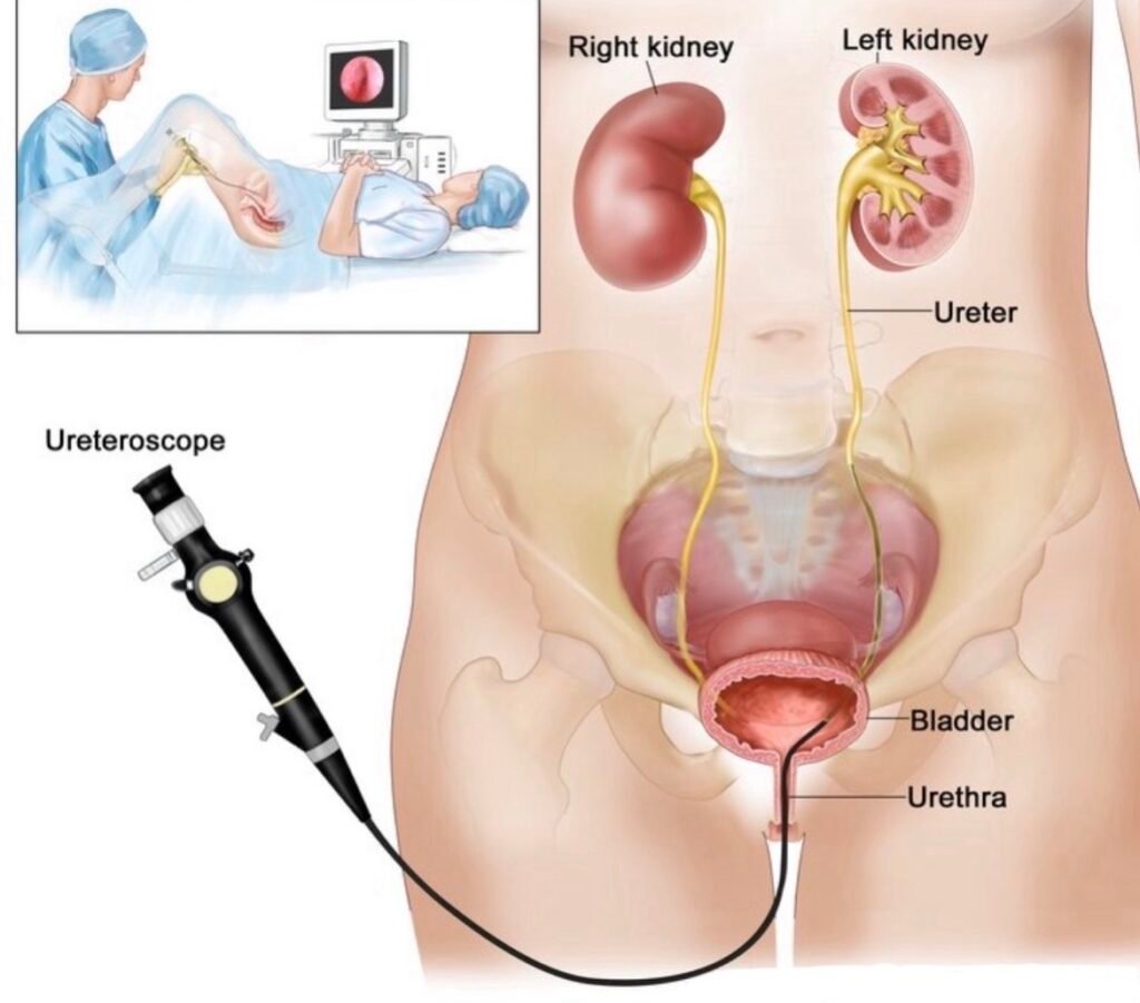 Kidney stone treatment