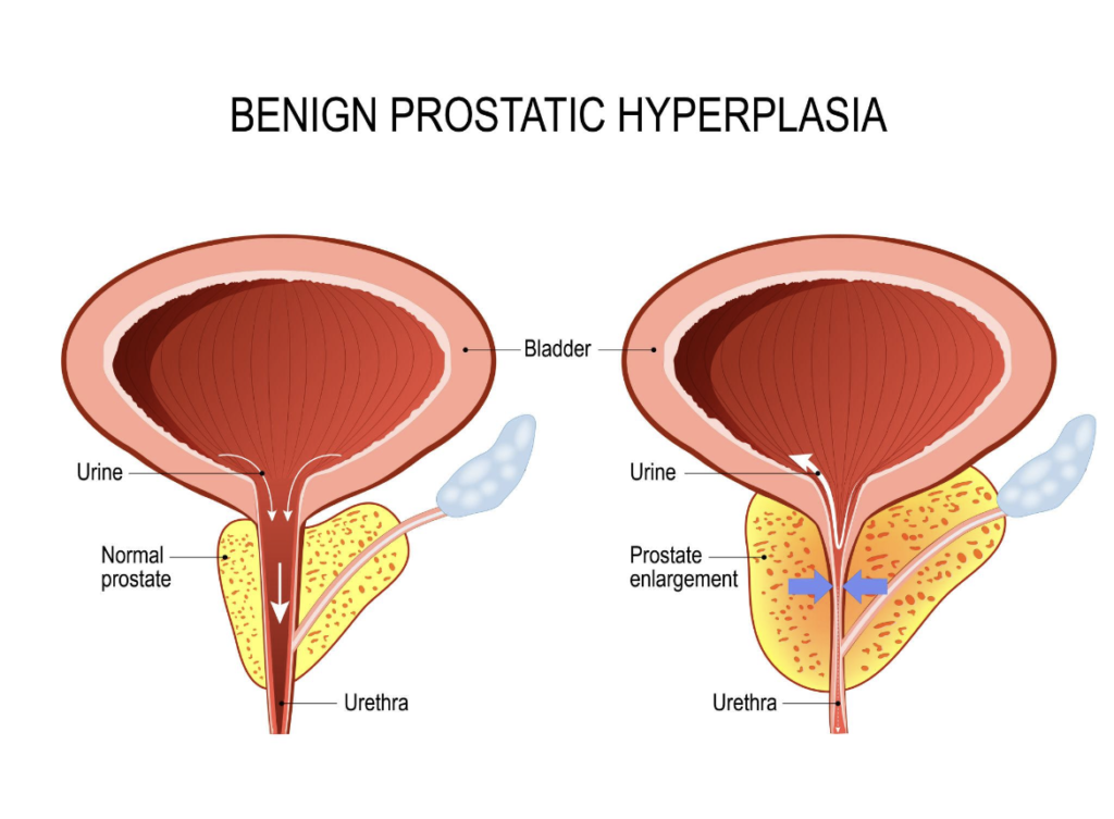 Prostate Symptoms