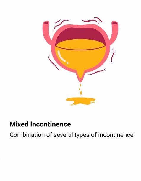 Mixed incontinence