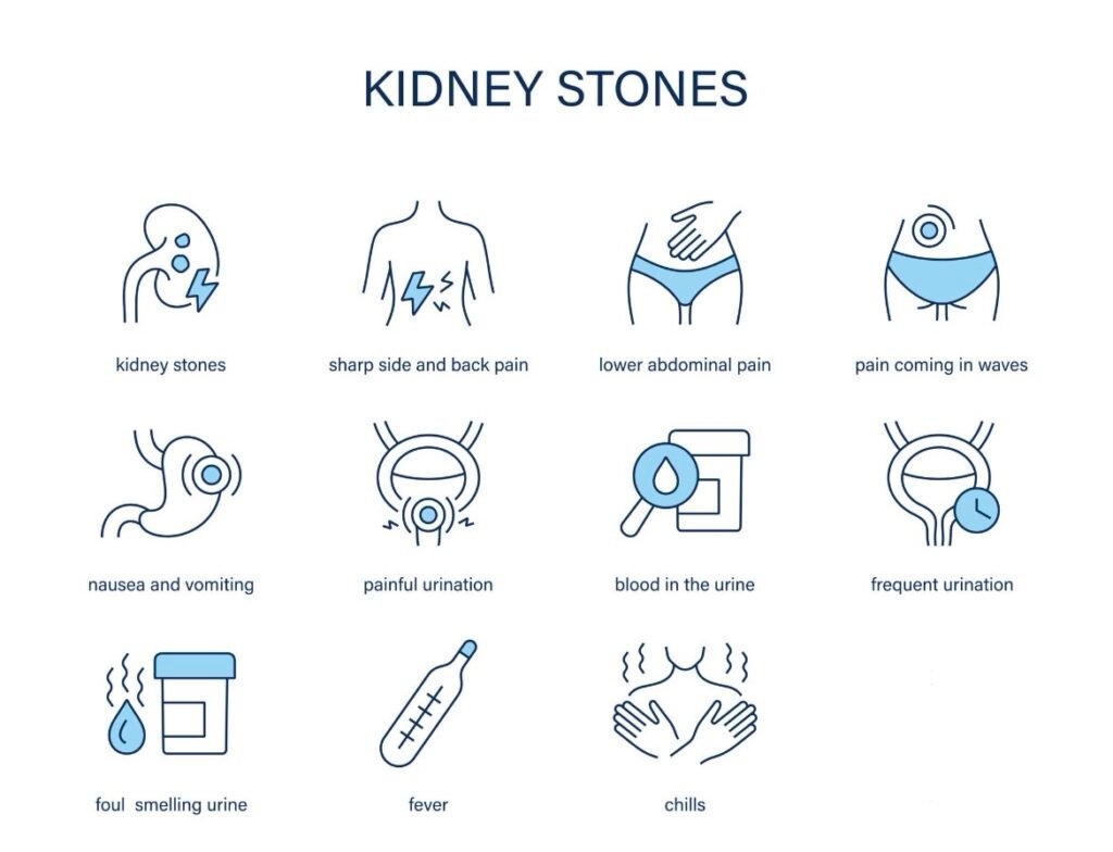 Kidney stone symptoms